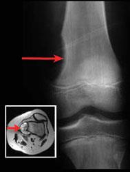 Bone tumor in the thigh