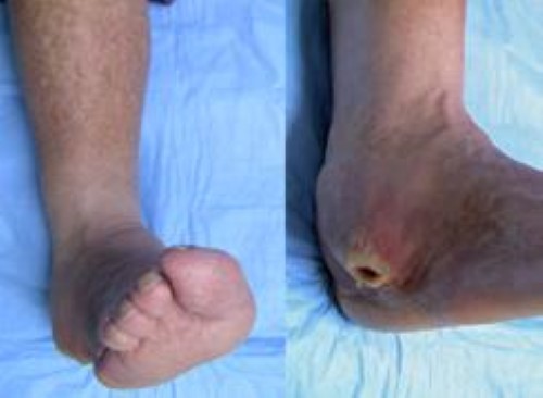 Diabetic (Charcot) Foot - OrthoInfo - AAOS
