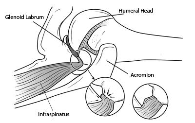 shoulder impingement