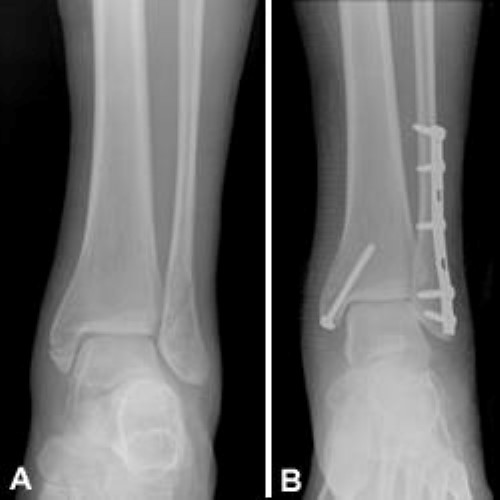 Understanding an Ankle Fracture