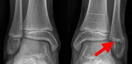 Ankle Fractures In Children - OrthoInfo - AAOS