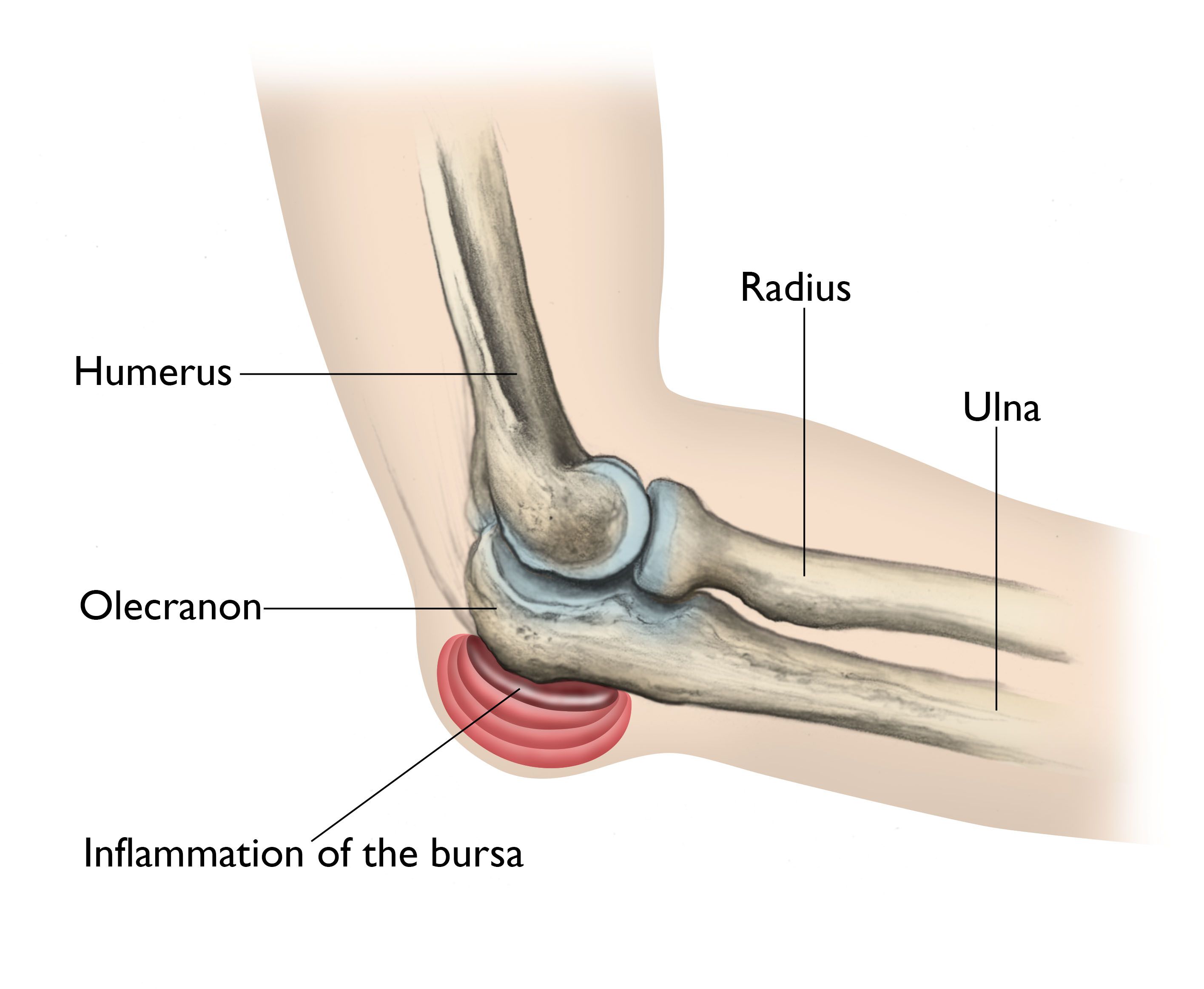 what causes septic bursitis