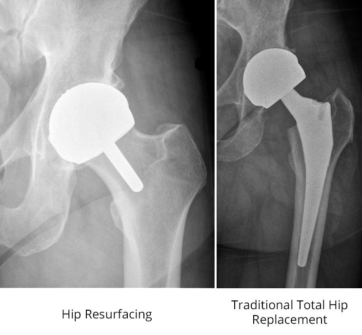 x-rays of hip resurfacing and total hip replacement