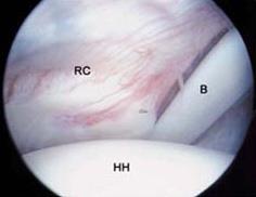 Arthroscopic view of inside the shoulder joint