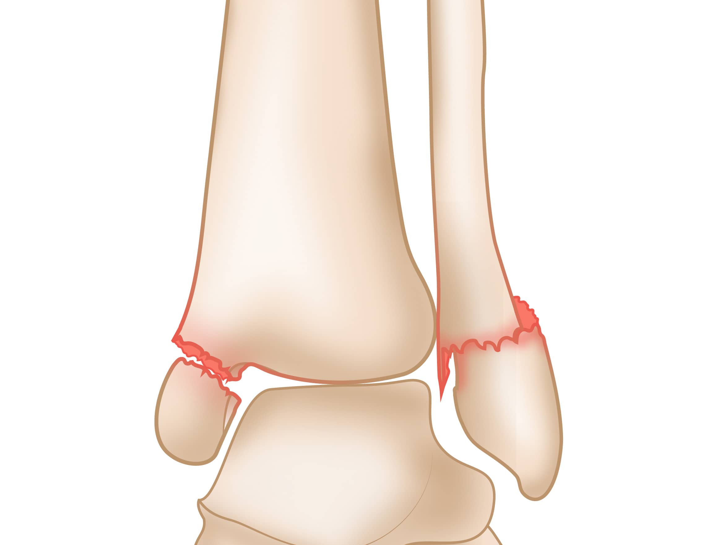 Bimalleolar Fracture