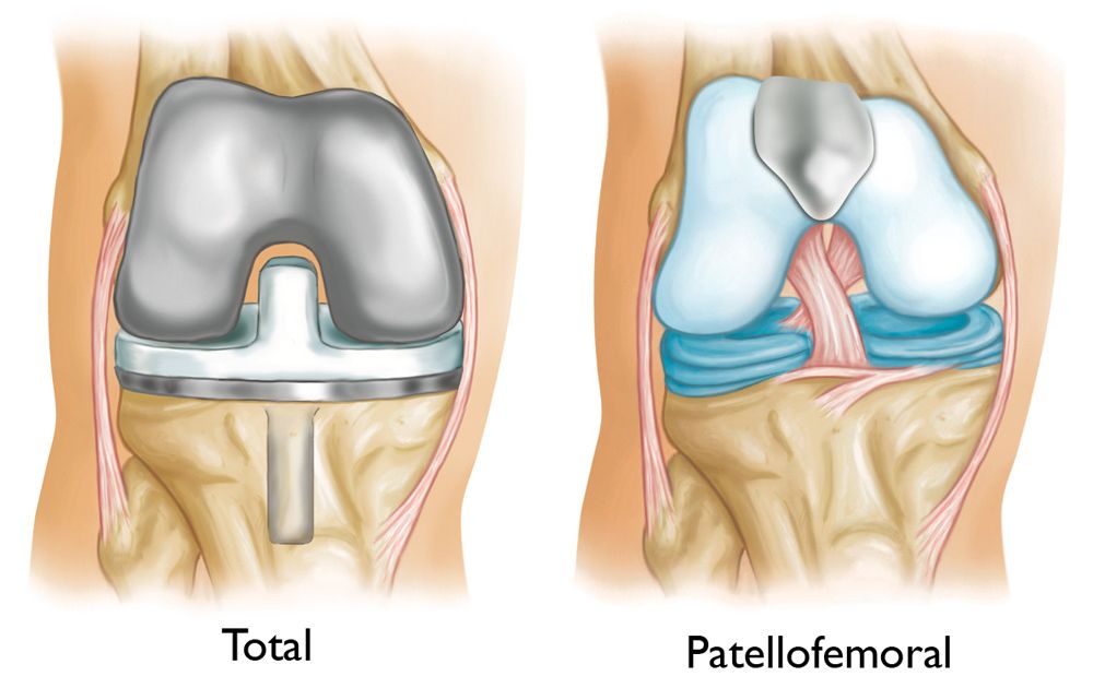 Illustration of total knee replacement and patellofemoral replacement