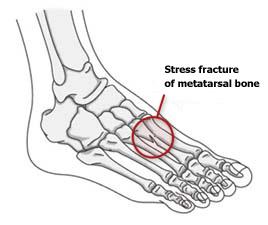 Stress Fracture Assessment amp Treatment - Newcastle Sports Medicine