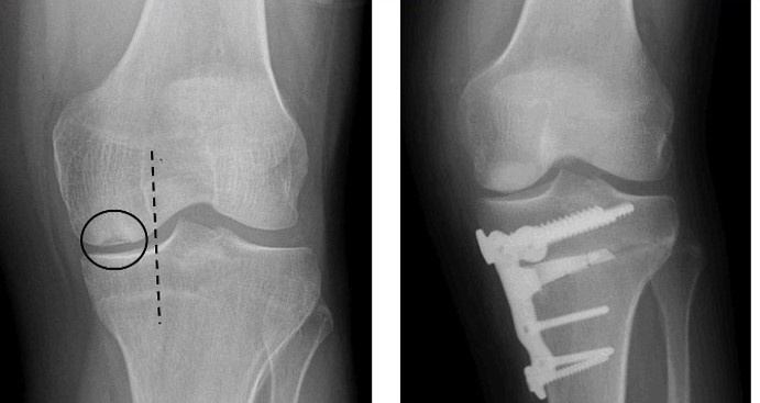 Open Medial Wedge Osteotomy Before and After X-rays