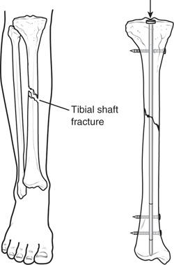 Tibia (Shinbone) Shaft Fractures - OrthoInfo - AAOS