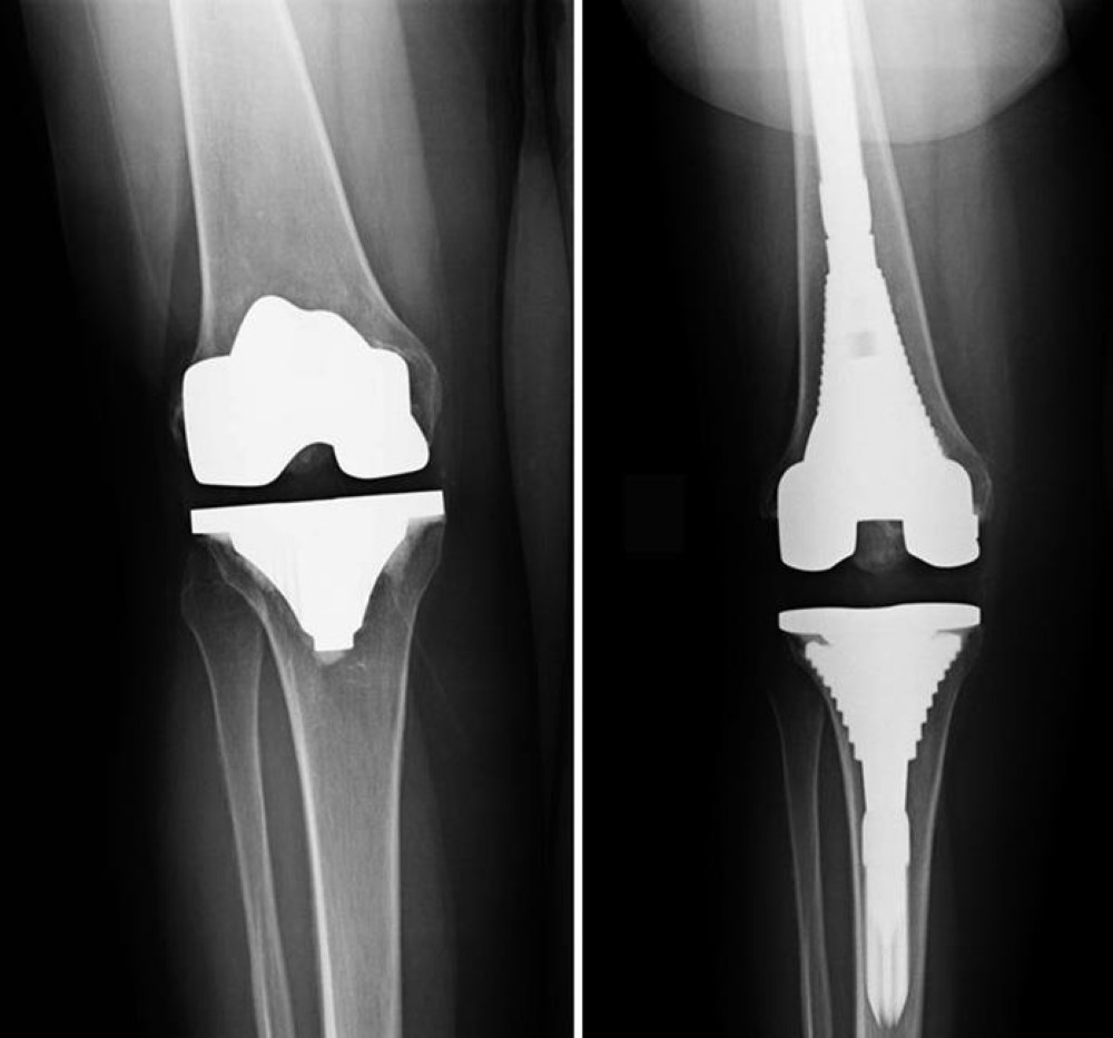 Total knee replacement x ray