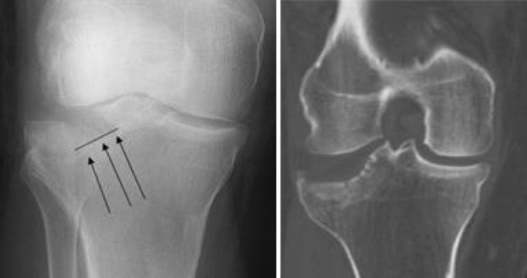 X-ray and CT scan of proximal tibia fracture