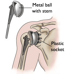 Total shoulder joint replacement