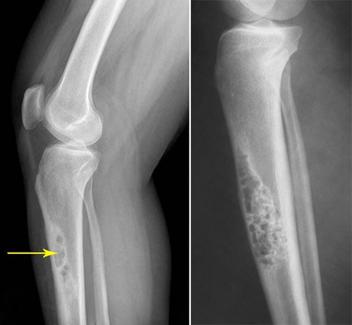 x-rays of OFD and adamantinoma