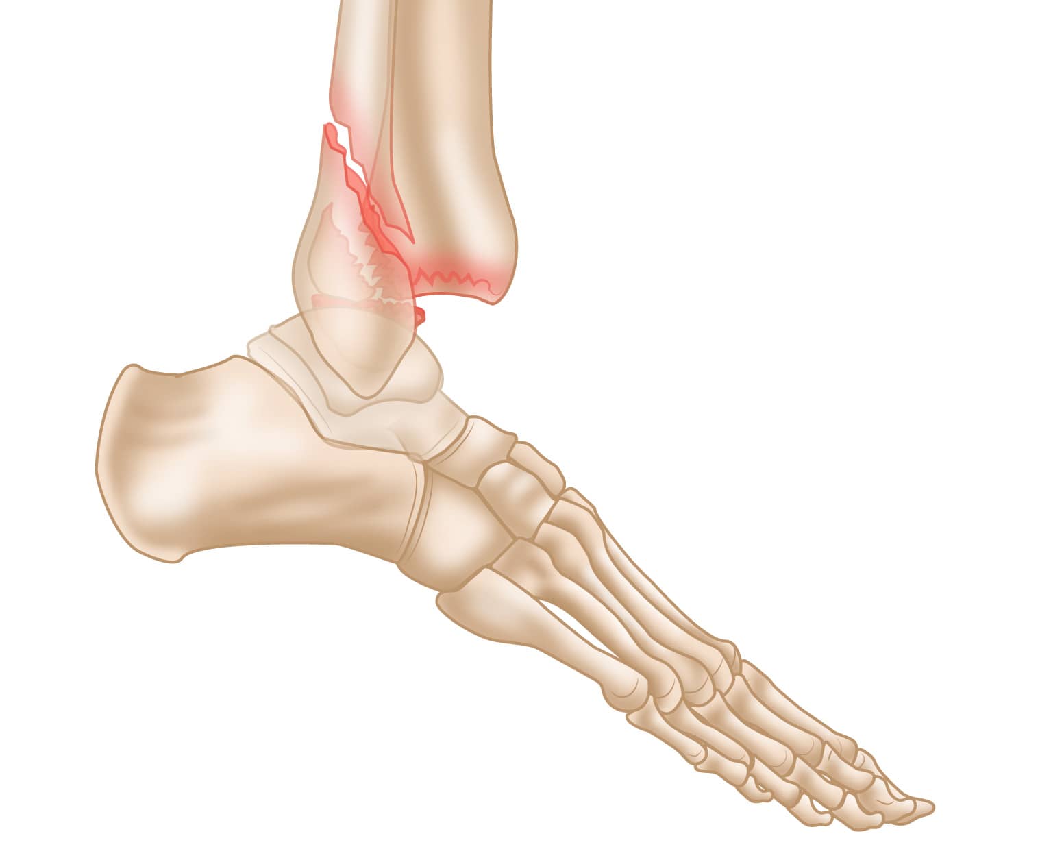 Trimalleolar Fracture Pain