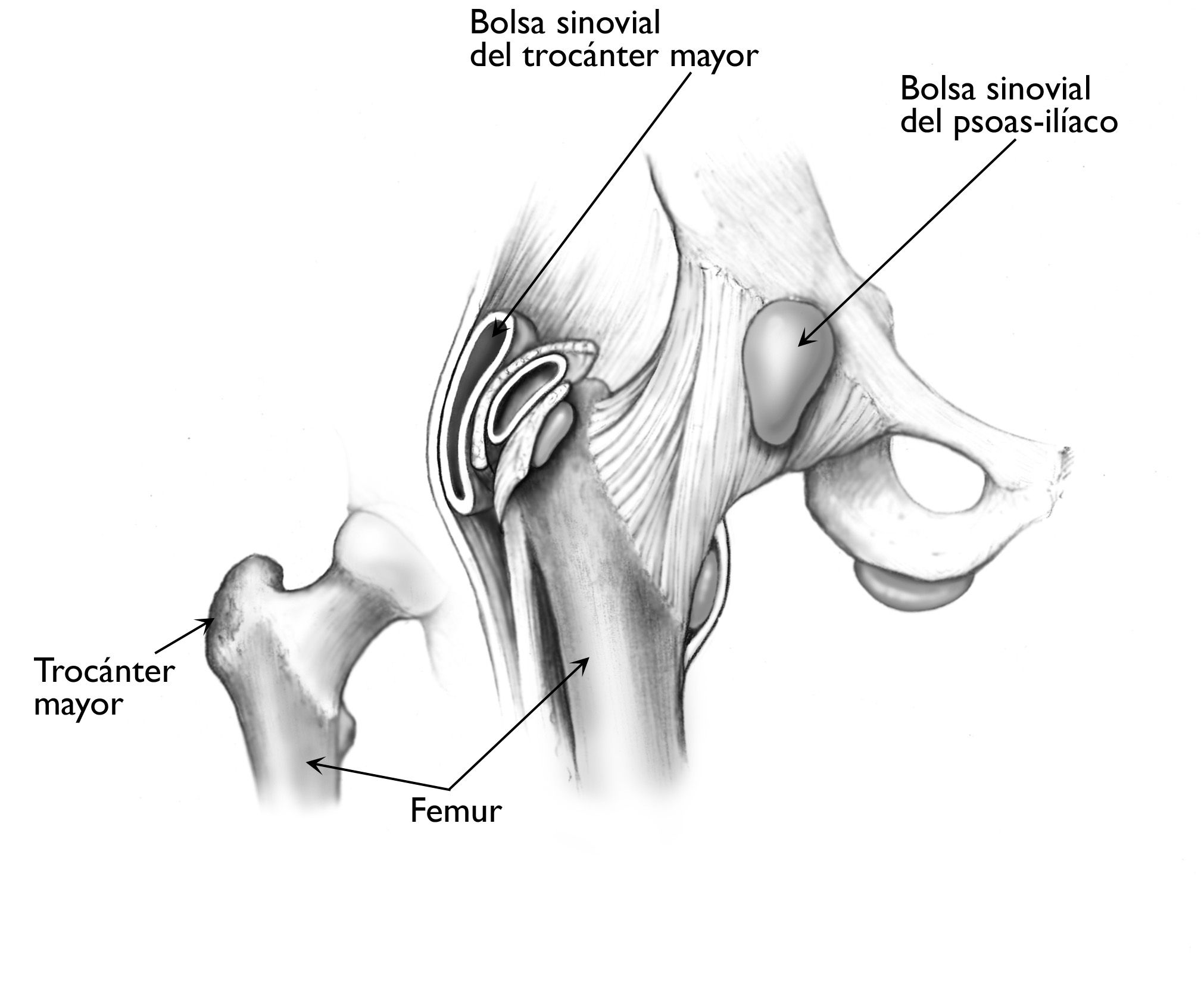 Lo más frecuente es que la bursitis de cadera involucre a la bolsa que cubre el trocánter mayor del fémur, aunque la bolsa del psoas-ilíaco también puede inflamarse. 