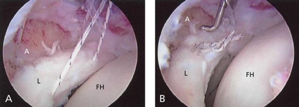 rthroscopic photo of labral repair