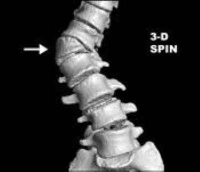 CT scan of hemivertebra in congenital scoliosis