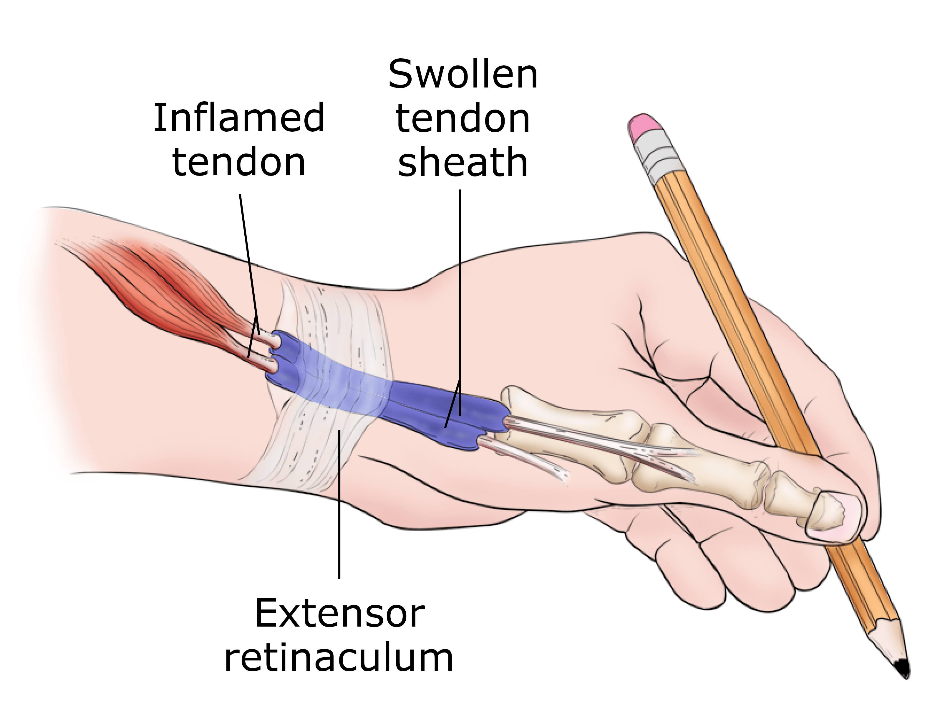 Extensor Tendonitis: What It Is, Causes & Treatment