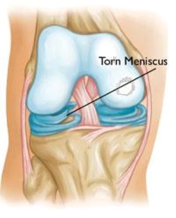 Patellar Tendon Tear - OrthoInfo - AAOS