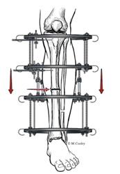 Nonunion treated with external fixator