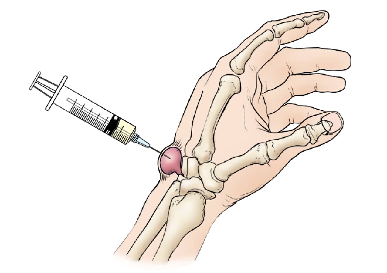 Ganglion Cyst of the Wrist and Hand - OrthoInfo - AAOS