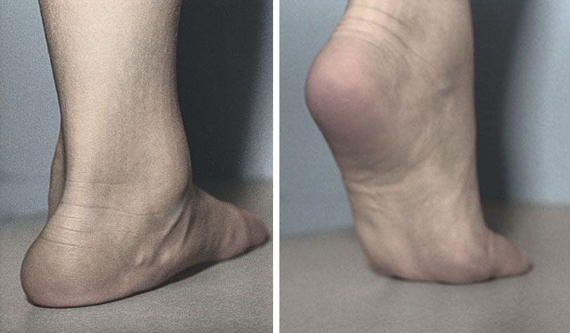 Flexible flatfoot