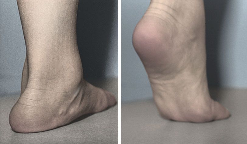 Flexible Vs. Rigid Flatfoot Condition in Kids - The Center Oregon