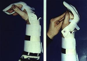 Splinting after surgery