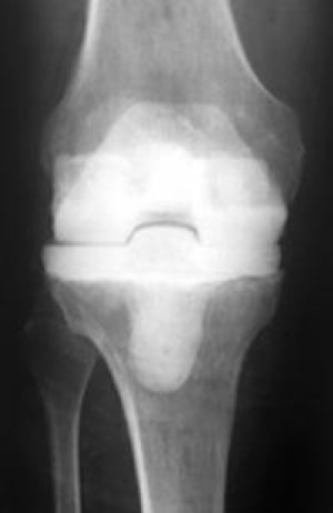 Does spiked tibial cement spacer reduce spacer-related problems in  two-stage revision total knee arthroplasty for infection?