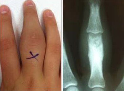 photo and x-ray of an osteoid osteoma