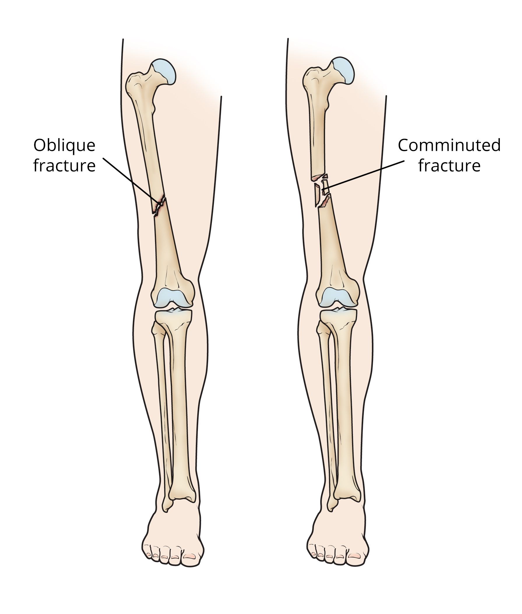 oblique fracture