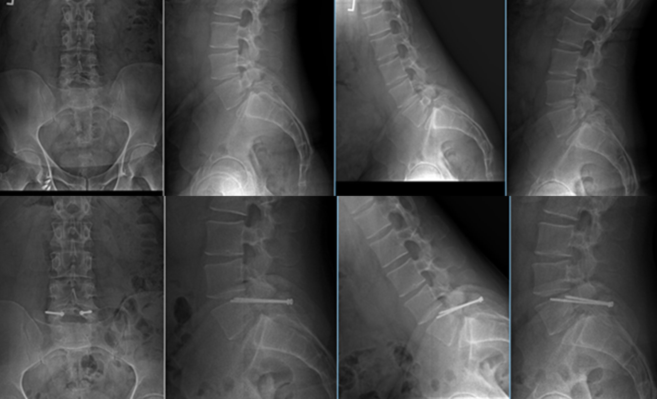 X-rays of Patient With Spondylolisthesis Before and After Pars Repair