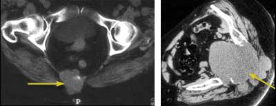 CT scans showing chordomas