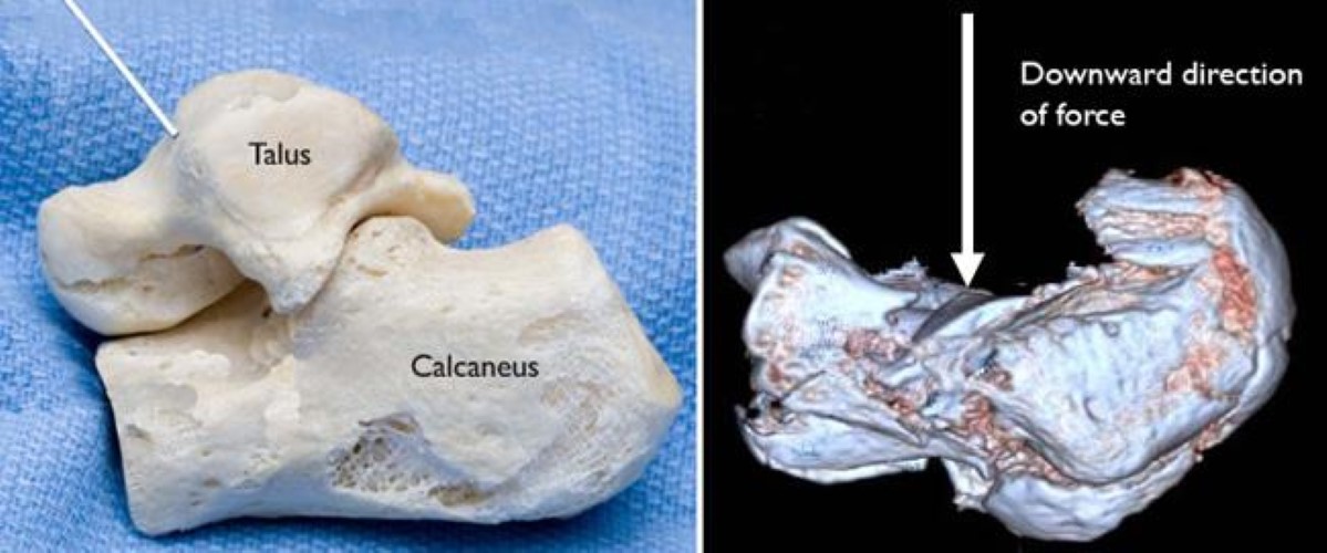 Model showing direction of force in a calcaneus fracture