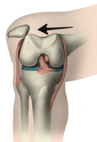 left patellar dislocation