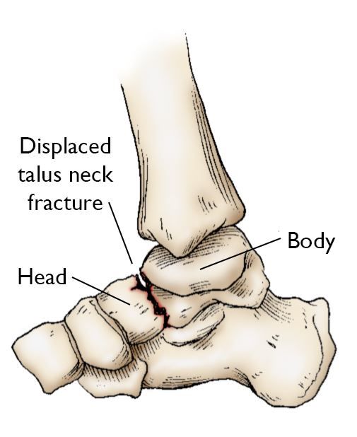 Talus neck fracture