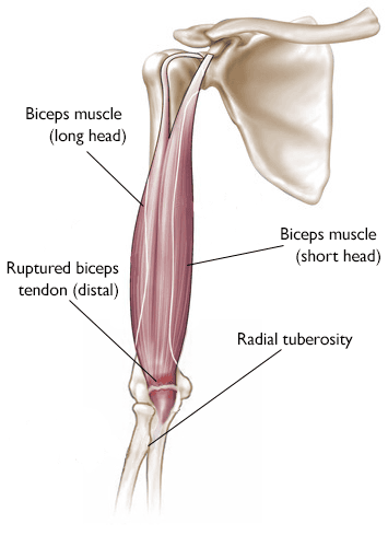 A complete tear of the distal biceps tendon