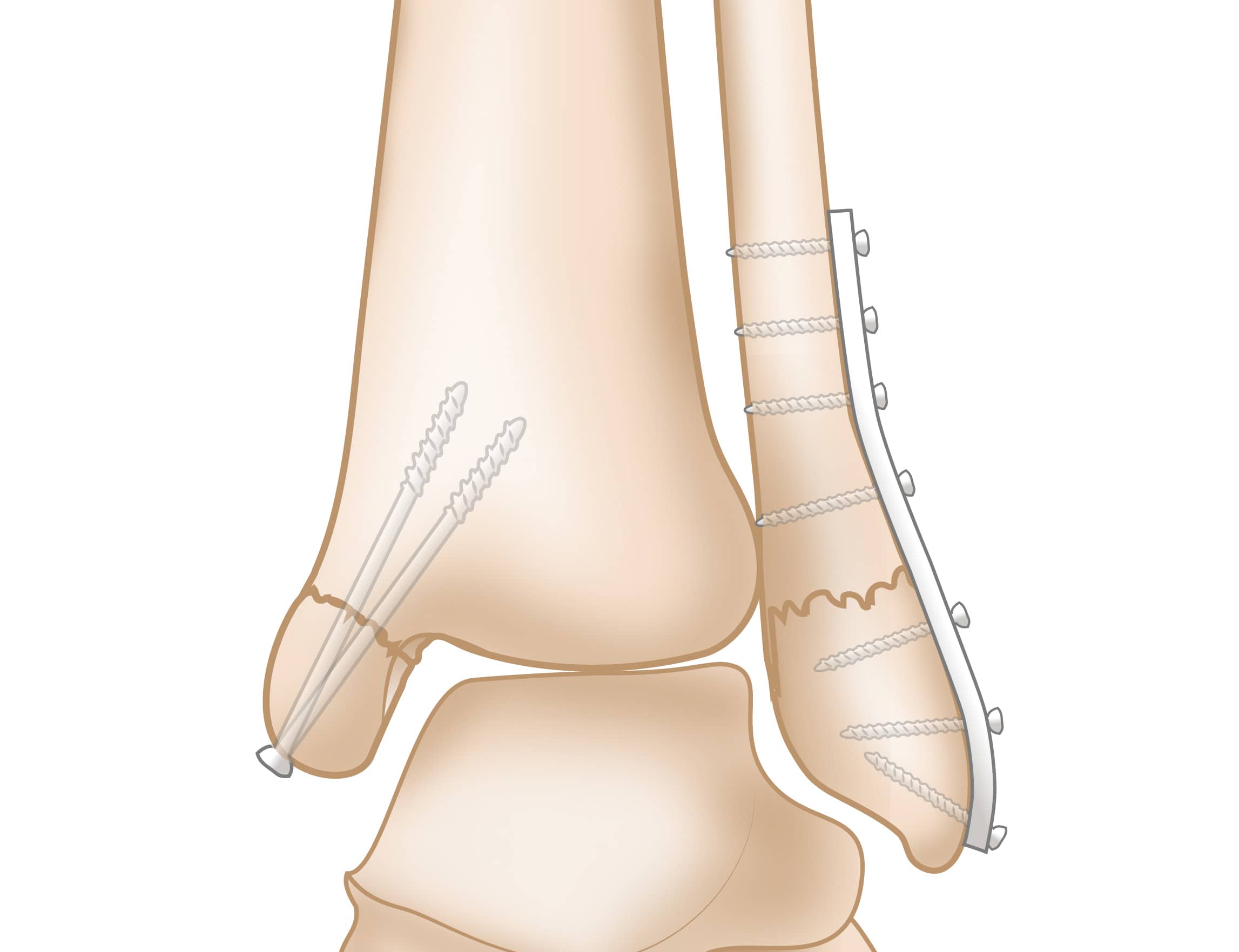 Surgical Repair of Bimalleolar Fracture