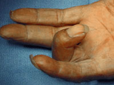 Trigger finger - Symptoms and causes - Mayo Clinic