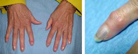 Arthritic fingers
