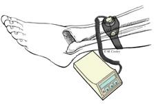 external bone stimulator