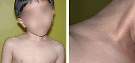 Congenital muscular torticollis