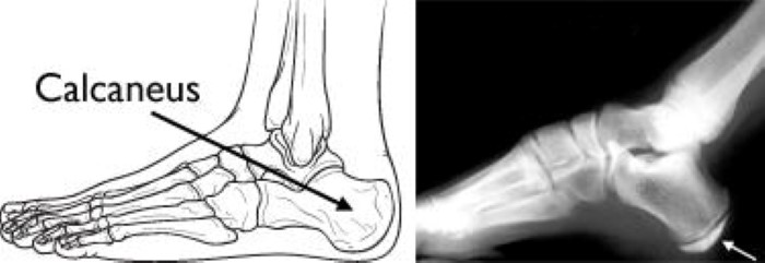 x-ray of Sever's disease