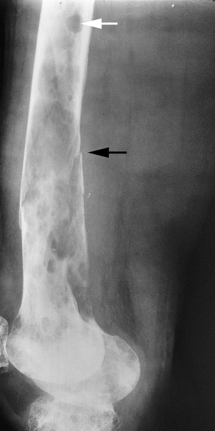 multiple myeloma x ray