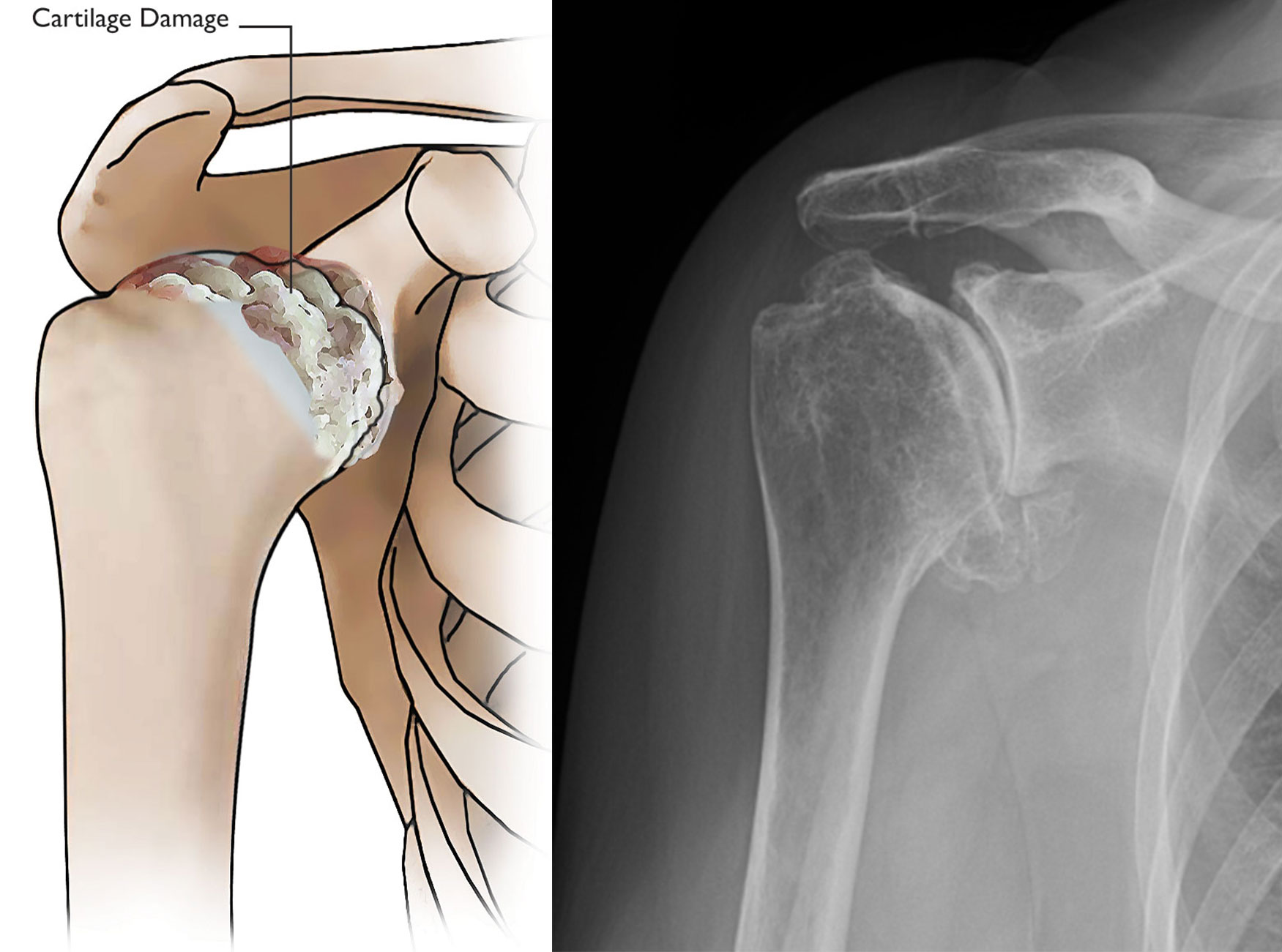Illustration and X-ray showing osteoarthritis of the shoulder