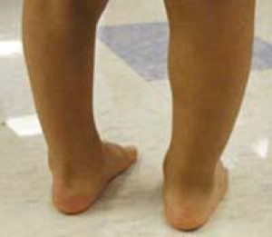 Child after treatment with Ponseti method for clubfoot 