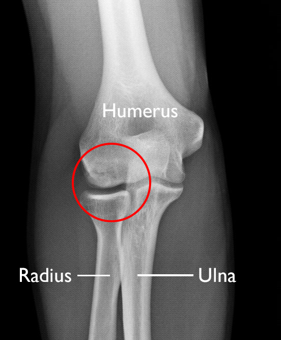 OCD lesion in elbow