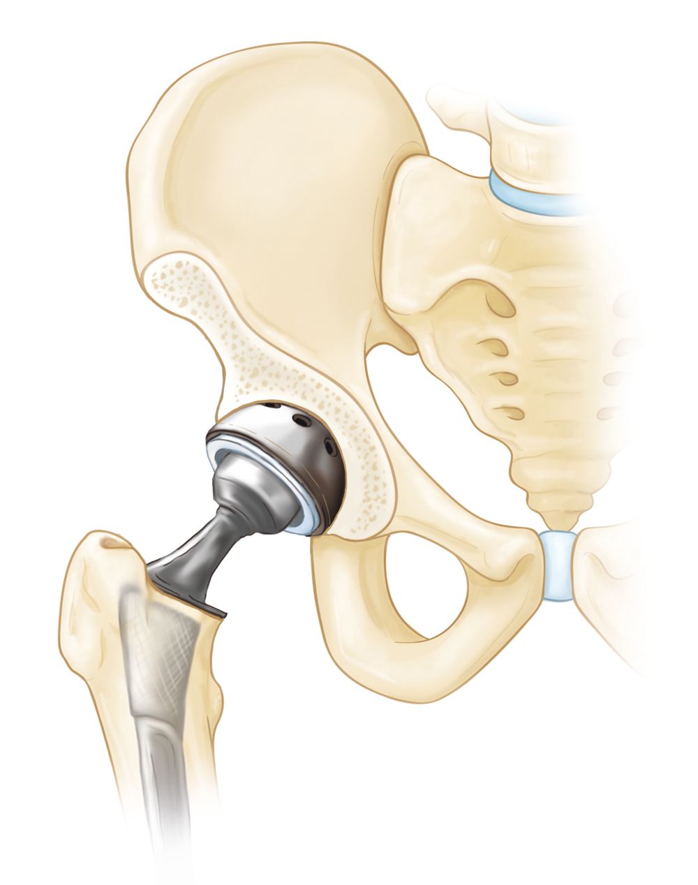 Total hip implants