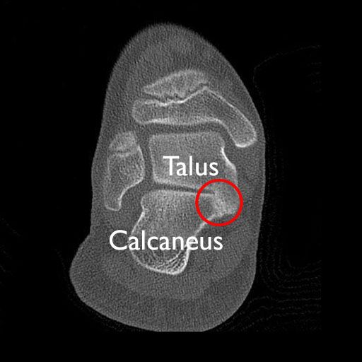 CT scan of tarsal coalition