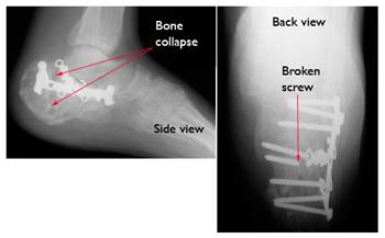 how to treat a broken calcaneus